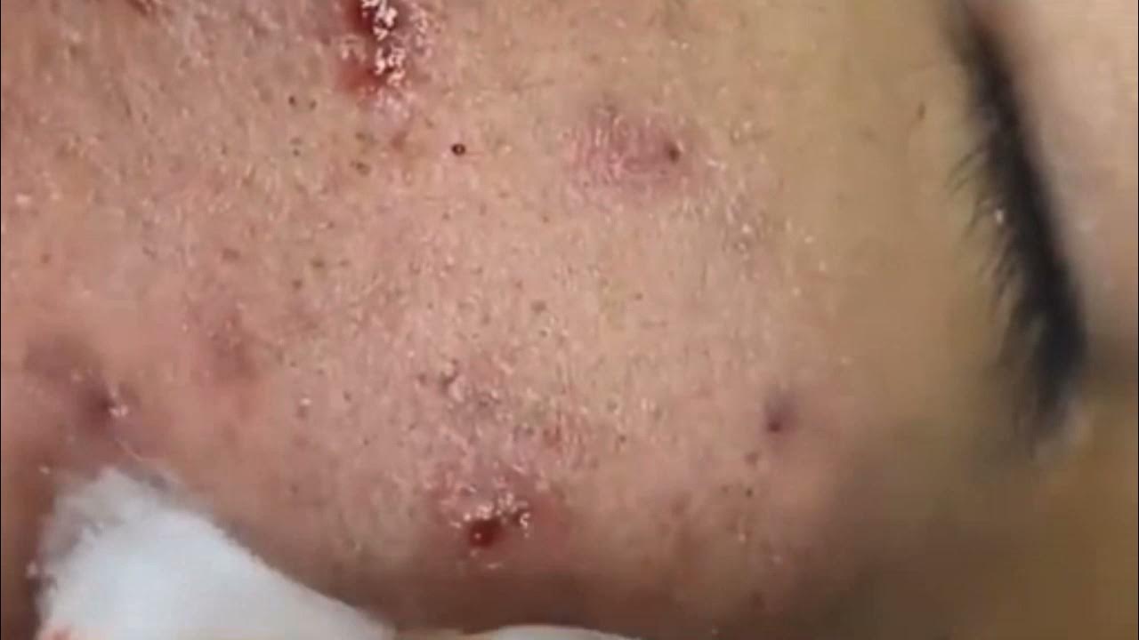 Acne Treatment(77)Black Mold Growing In Ear Canal YouTube