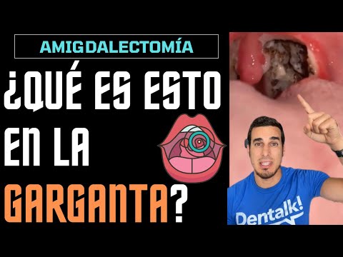 Video: ¿Qué aspecto tienen las amígdalas normales?