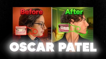 Thumb Pulling: Dr. Mike Mew Speaks Out