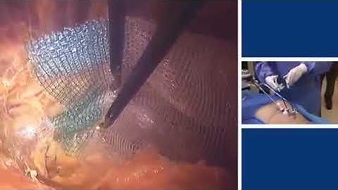 Самофиксирующаяся сетки Covidien ProGrip