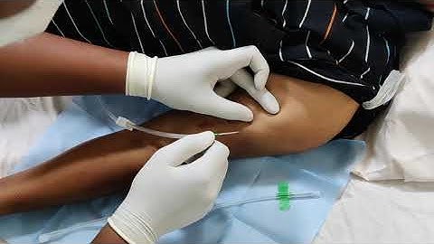 Hemodialysis Parmanent Access:  AV Fistula Cannulation