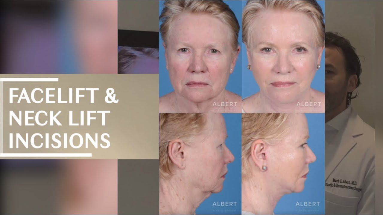 FaceLift &NeckLift Incisions