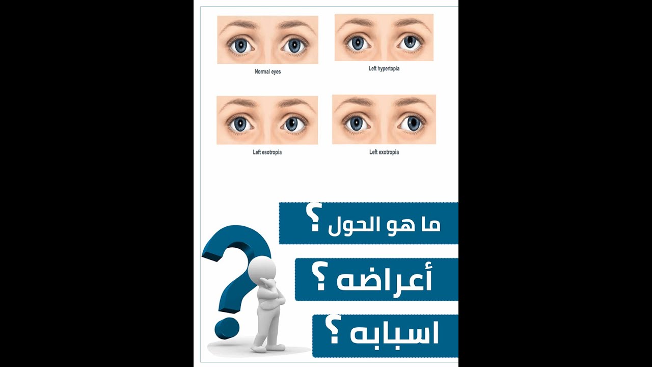 الحول وطرق فحصه الجزء (2)  ( Strabismus ( Diagnostic test