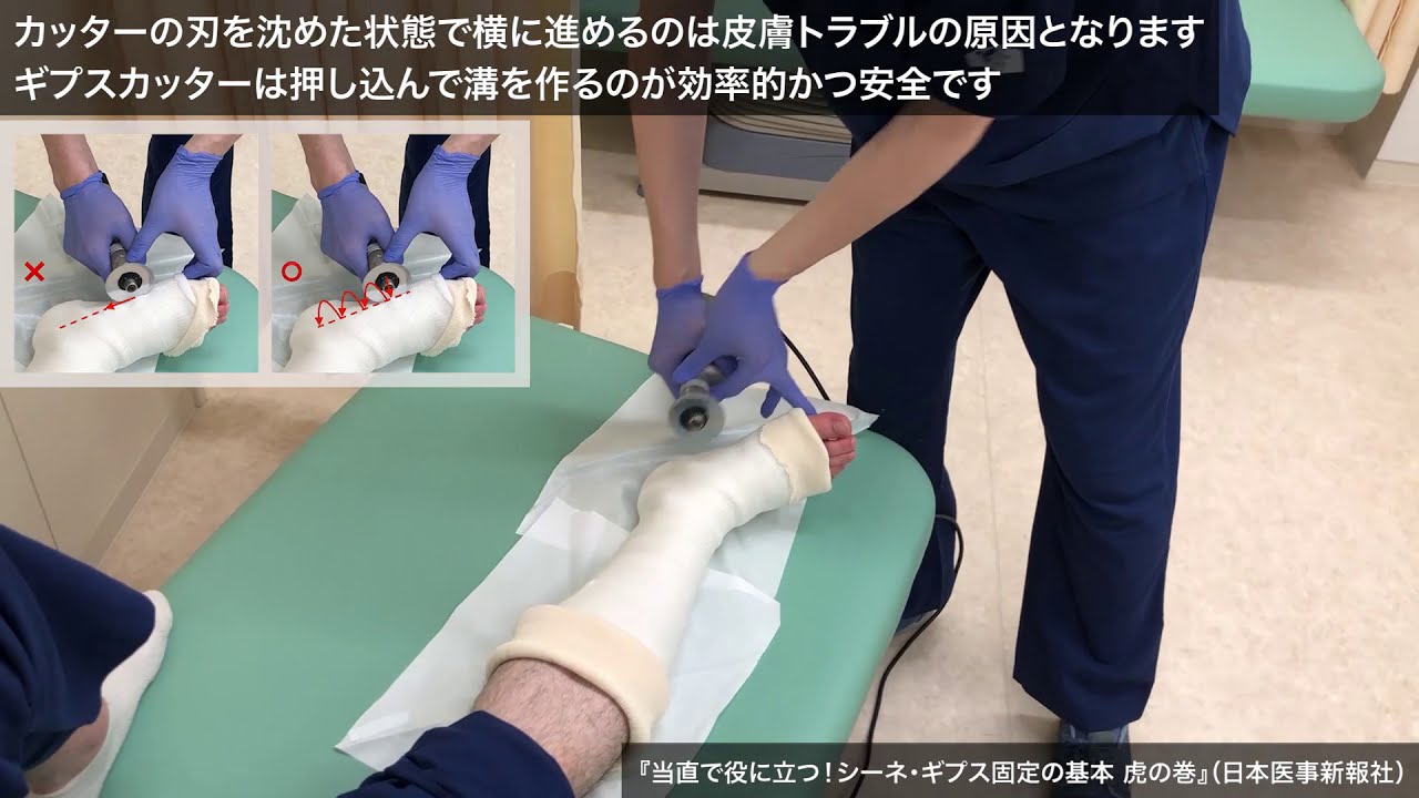 動画7「ギプスカット:右下肢をギプスカットしている様子」 YouTube 動画7「ギプスカット:右下肢をギプスカットしている様子」 YouTube
