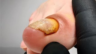 Давление в углах перешло в отёк кутикулы