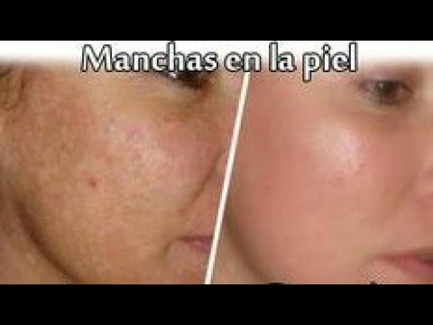 Como quitar las manchas dela cara en una semana