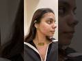 Laser Treatment For Acne Scars Is It Worth It Check Description For Details Youtubeshorts 
