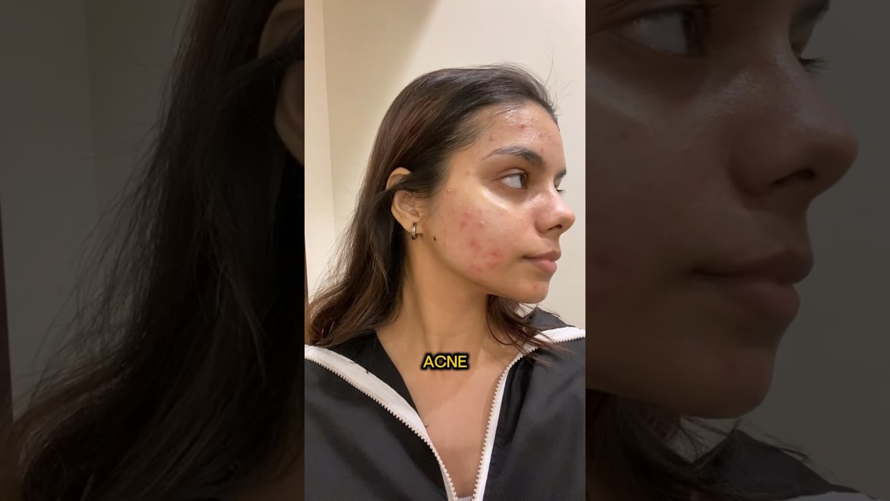 Laser treatment for Acne Scars ‼️ is it worth it? Check description for details #youtubeshorts
