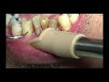 上尾の歯医者の歯周病・口臭予防の歯石取り動画 R5年8月11日 | 健康・口腔ケア
