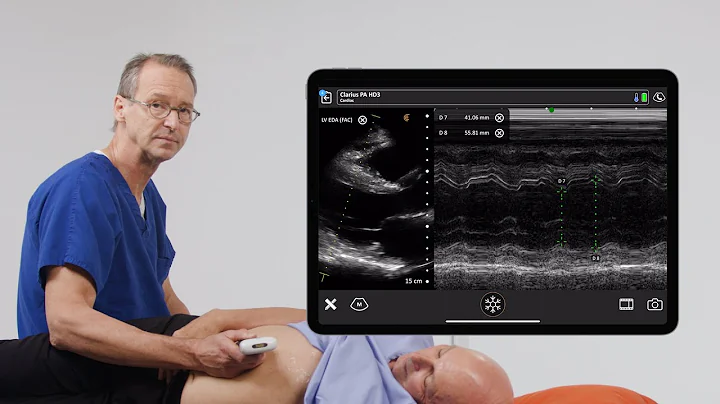 How to Measure Fractional Shortening