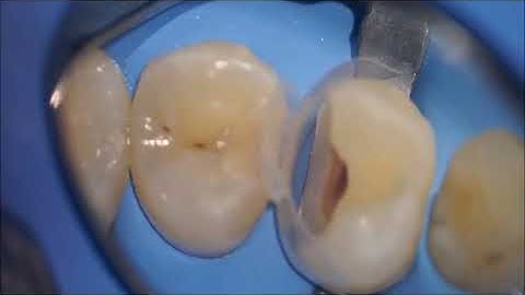 composite class 2 with Injection molding