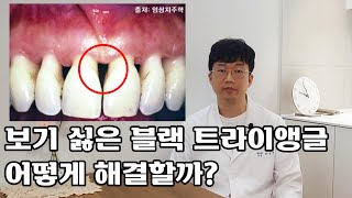 치아 사이 검은 공간인 블랙 트라이앵글의 수복이 잇몸에 주는 영향