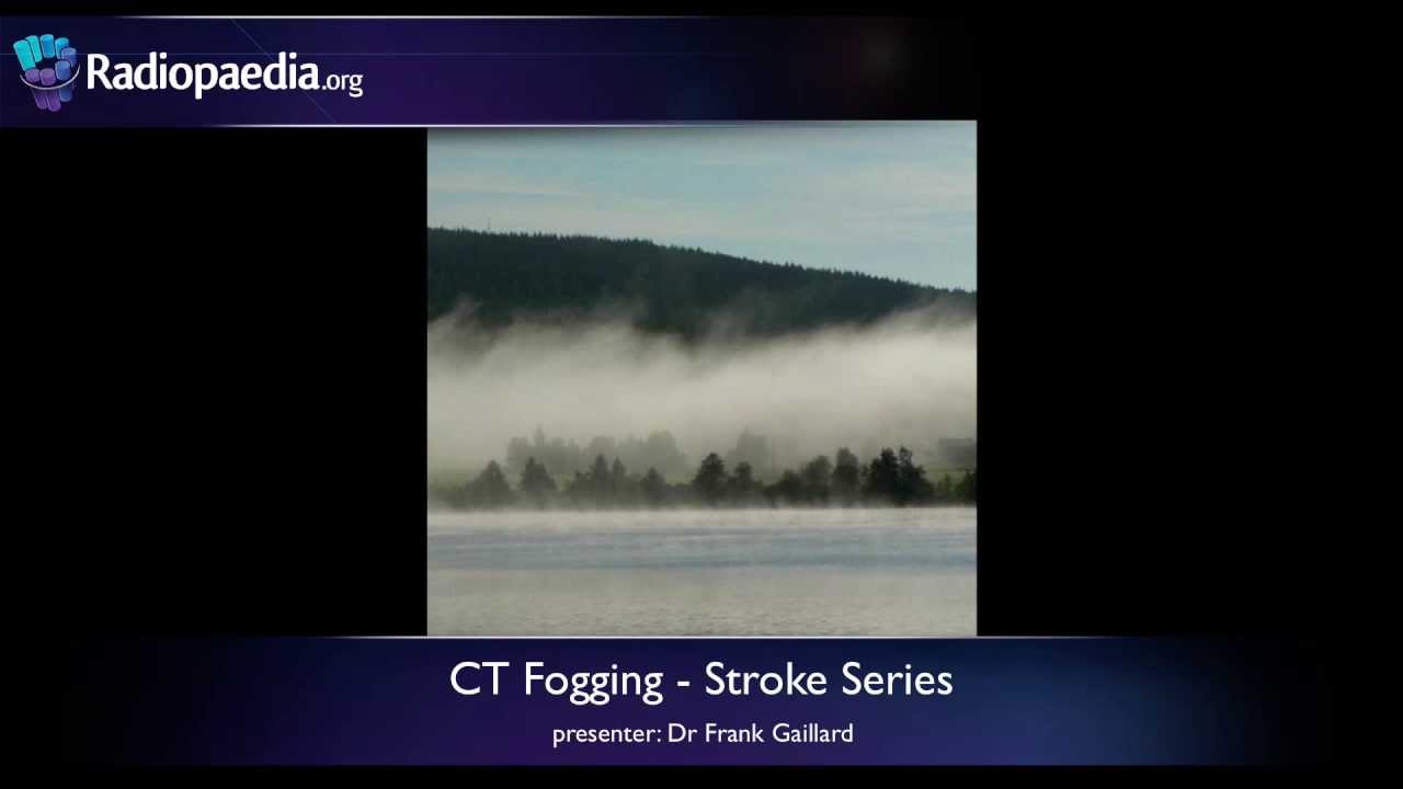 Stroke Fogging phenomenon on CT radiology video tutorial YouTube