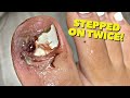 Traumatized Infected Ingrown Nail Removal!