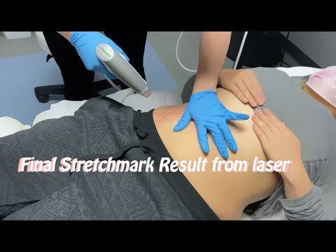 Final stretch mark removal treatment (sublative laser) the results... not what i expected