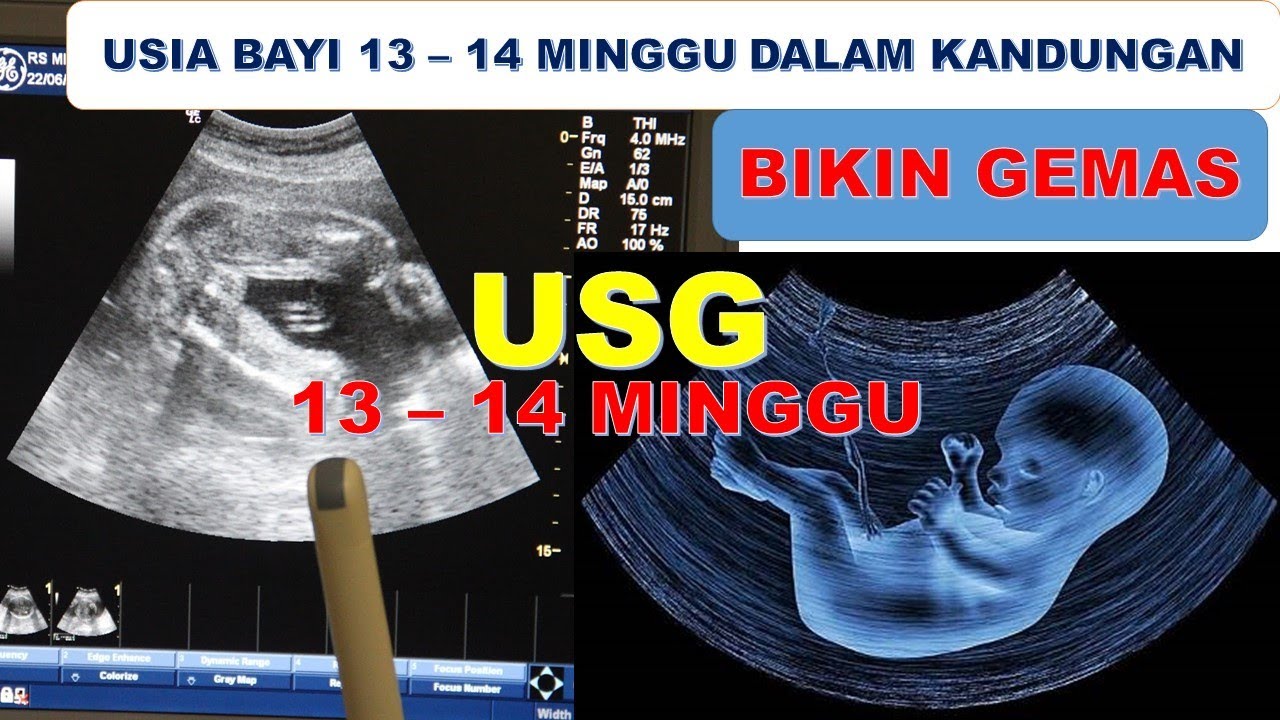 Usg Bayi Dalam Kandungan Usia Kehamilan 13 14 Minggu Janinnya