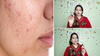 Only 1 drop and pimple gone | Home Remedy to remove Pimples