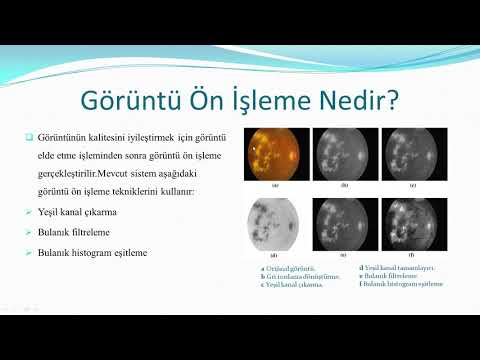 Video: MATLAB ile Diyabetik Retinopatinin Otomatik Tanısı: 33 Adım Video: MATLAB ile Diyabetik Retinopatinin Otomatik Tanısı: 33 Adım