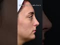 Scarless Rhinoplasty