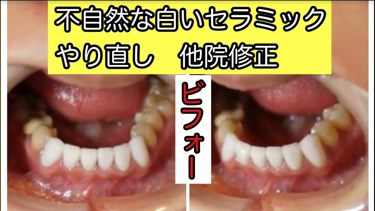 他院修正 白すぎるセラミック改善 セラミック矯正1 2 Youtube