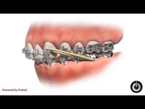 Proses gigi kawat (behel)