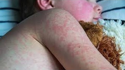 Measles Outbreak: What You Need to Know & How to Stay Safe!