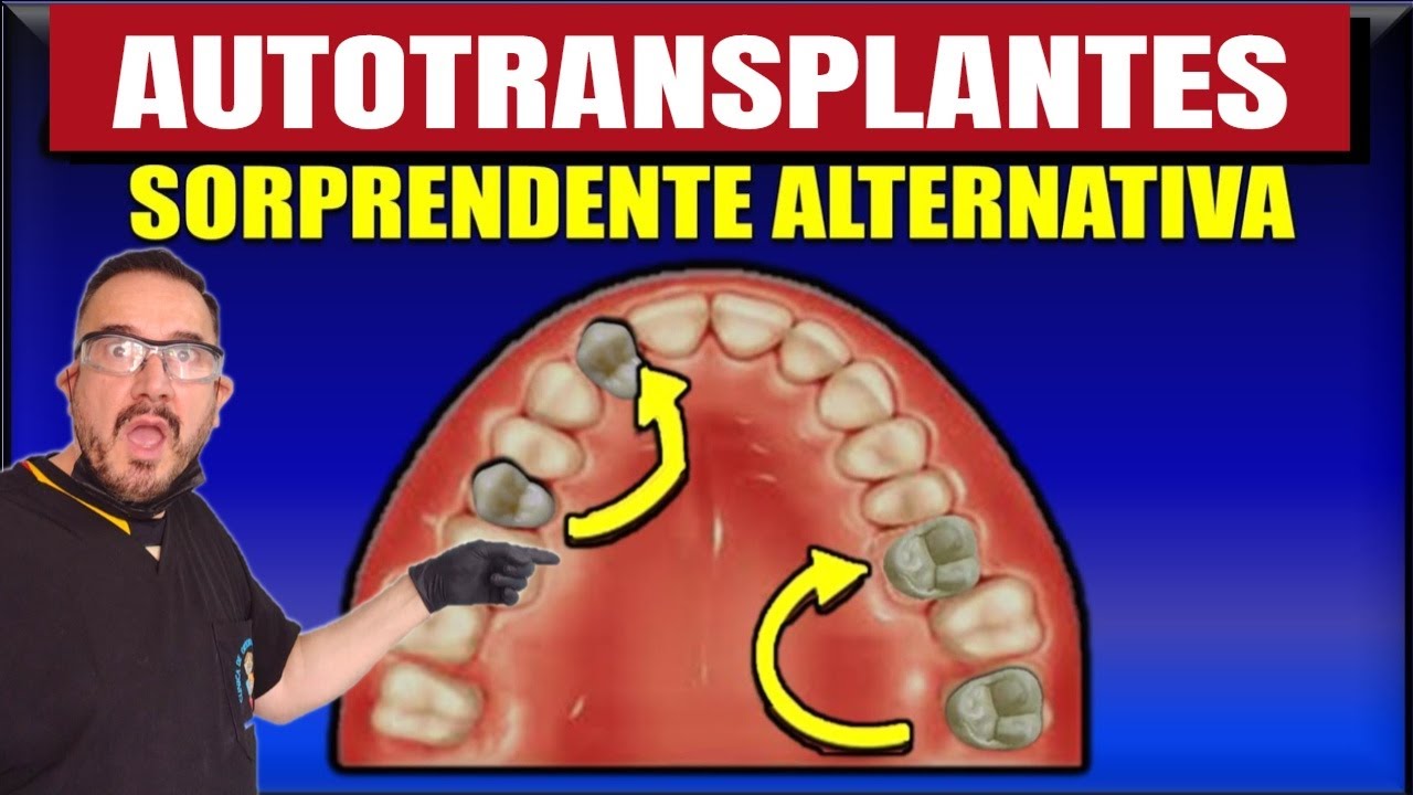 Así funciona el Autotransplante Dental: EXPLICADO Fácil!