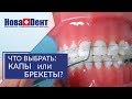 Брекеты или капы. ❓ Какой вариант лечения выбрать — брекеты  или капы. НоваДент. 12+