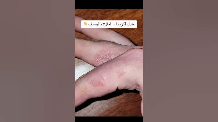 حبوب صغيرة مؤلمة على اليدين عند النساء 😱😱
