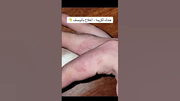 حبوب صغيرة مؤلمة على اليدين عند النساء 