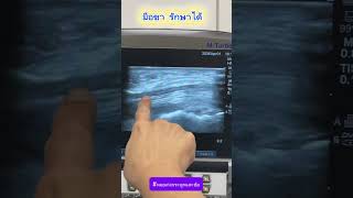 มือชา รักษาได้