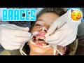 THIRTEEN YEAR OLD GETS BRACES FOR THE FIRST TIME ON TOP AND BOTTOM | MIDDLE SCHOOL BRACES