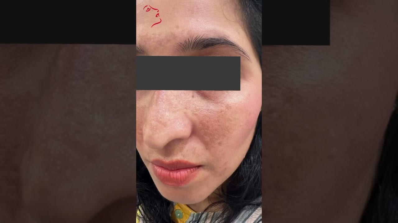 Melasma Treatment Results