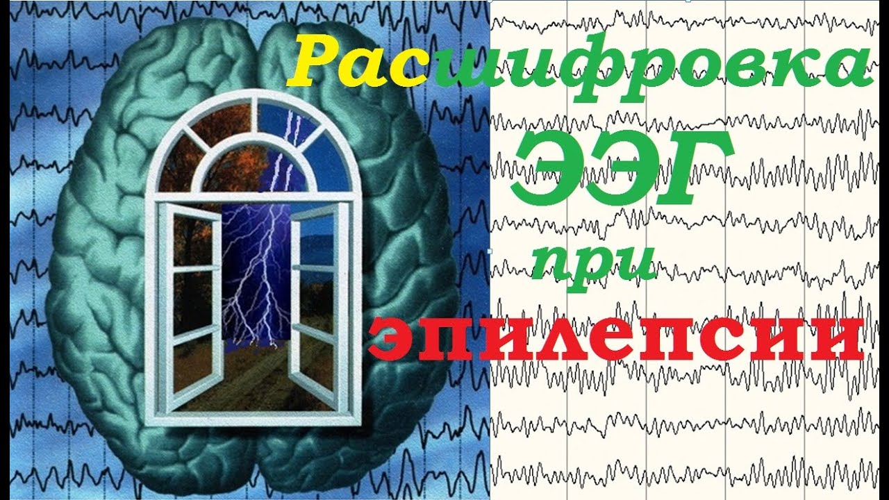 Как расшифровать заключение своей ЭЭГ при эпилепсии или подозрении на ...