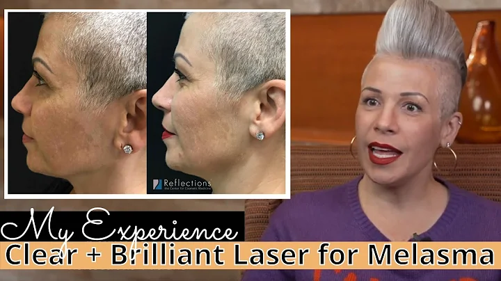 Kimberly's Experience with Clear + Brilliant Laser...