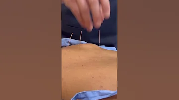 ASMR الاسترخاء في تدليك Tuina الصيني والوخز بالإبر Shorts 