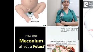 What is Meconium? Meconium kya hota hai? Baby meconium kab pass karata hai? when baby pass meconium