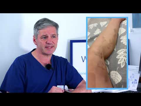 Video: Ader Sclerotherapie Procedure