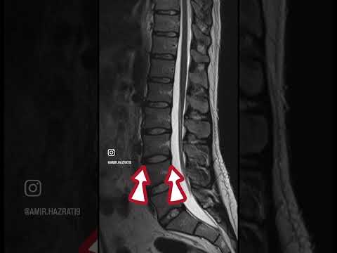 ام آر آی کمر