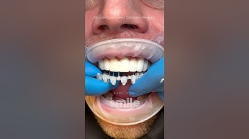 20 Upper/Lower Milled Composite Veneers #shorts