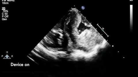 Soft robotic sleeve supports heart function - Movie 3 - Echocardiogram