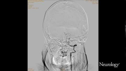 Rupture of vertebral artery dissection aneurysm during 3D DSA