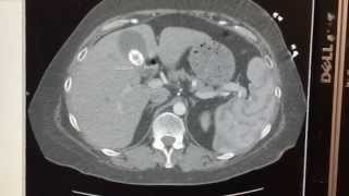 Cholelithiasis On Ct Scan