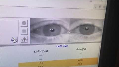 Minnesota Concussion recovery- Vertical OPK testing VNG