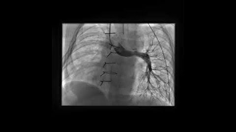 LPA angiogram in LAO view in a patient post Right BDG anastomosis