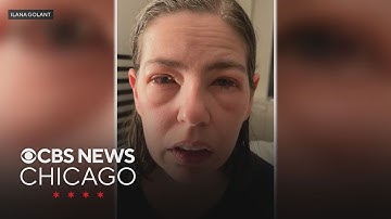 Northwestern scientists say asthma drug zileuton could stop life-threatening food allergies