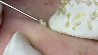 Выдавливание черных точек и прыщей 2023 Blackhead and Pimple Removal The Ultimate Guide