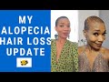 Alopecia diagnosis | update journey | patience is a virtue