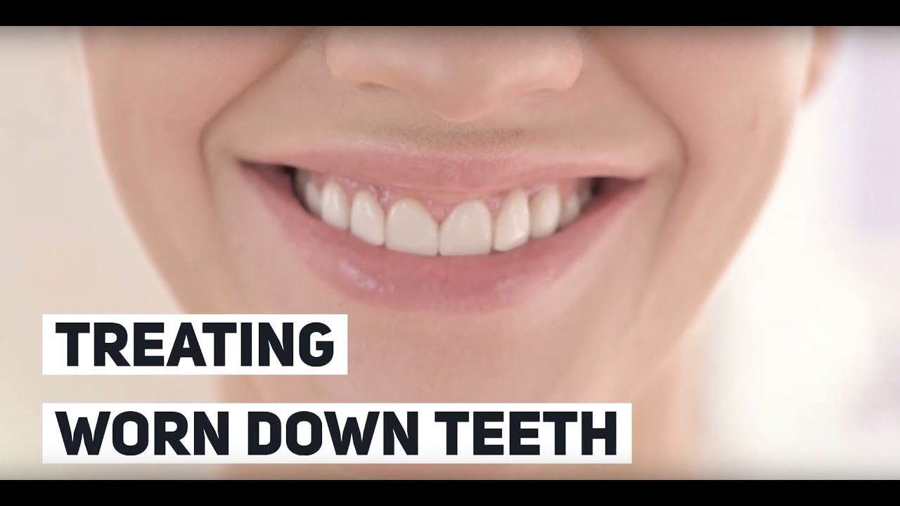 Treating Worn Down Teeth Flatrock Family Dentistry YouTube