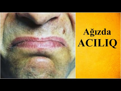 Video: Acılıq Ağız Doludur